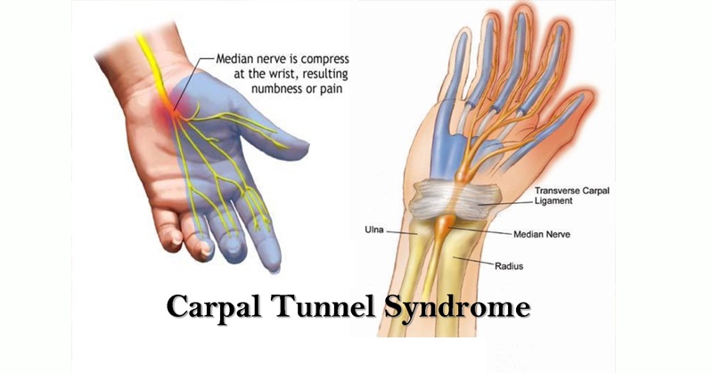 carpal tunnel syndrome.jpg